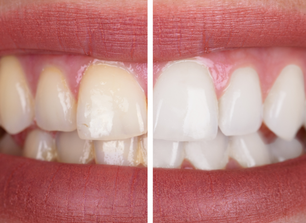 Comment faire face au jaunissement des dents : Guide complet pour un sourire &eacute;clatant